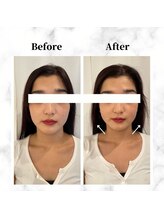 ザビューティー 麻布十番本店(The Beauty)/12Dリフト全顔打ち放題[リフト]