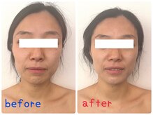 ソラ(Sola)/ビフォーアフター：小顔筋膜T