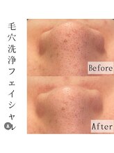 レイプラス イオン卸町店(RAY PLUS)/【before⇒after】毛穴洗浄