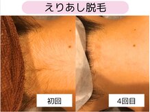 ウルル 四日市駅前店(ULULU)/えりあし脱毛