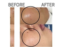 ライム 浦和(LIME)/ ハーブピーリング｜赤みケア