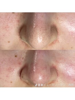 ビューティータワー(Beauty Tower)/毛穴洗浄直後ビフォーアフター