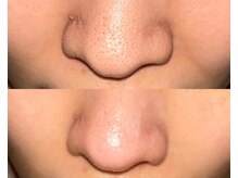 ル シーニュ/毛穴エクストラクション