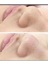 アンヘル(Angel)/毛穴洗浄