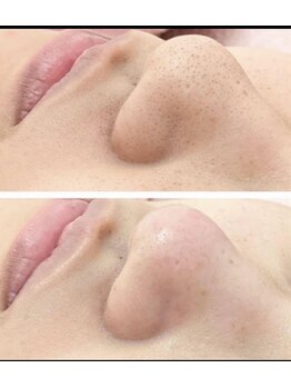 アンヘル(Angel)/毛穴洗浄