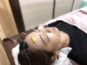 いりや鍼灸整骨院の写真/【たるみ&肌質改善に!】美容鍼で内側から美しさを呼び覚ます♪ほうれい線/くすみ/小顔/リフトアップに◎