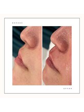 ブランスキンラボ(BLANC.skin LAB)/フェイスワックス脱毛