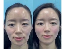 筋膜×経絡を組み合わせた相乗効果◎