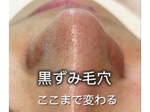 ミント(Mint)の雰囲気（SNSで大バズり中！話題の韓国式3D毛穴洗浄。汚れをごっそり吸引）