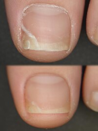 子どもの爪トラブル