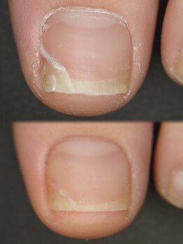 エンネイル(en.nail)/子どもの爪トラブル