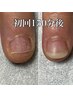 【深爪矯正】爪噛みむしり癖の深爪が人工爪で即ナチュラル美爪