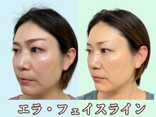 ナチュラルパーフェクトフェイス 新宿/横顔エラ張りスッキリ/新宿小顔