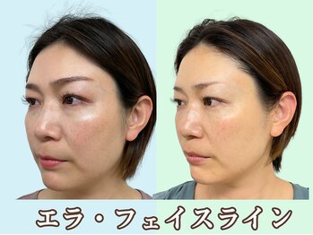 ナチュラルパーフェクトフェイス 新宿/横顔エラ張りスッキリ/新宿小顔