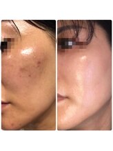 エヌ アンド エイチ ソニックフィット(N&H sonicfit)/最新美容！幹細胞培養上清液導入