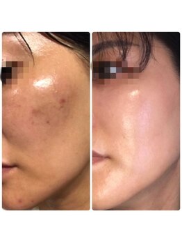 エヌ アンド エイチ ソニックフィット(N&H sonicfit)/最新美容！幹細胞培養上清液導入