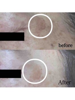 ブランシェ 野々市店 × 椿/シミケア　お客様