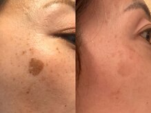 エヴェリーナ(Eveliiina)/極上シミケア30分