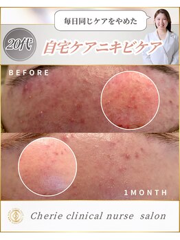 シェリー(Cherie)/施術なし！長年のニキビケア