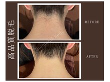 【一生モノの高品質脱毛】で毛穴もキレイにしっかり実感できる!