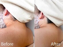 ライトウェーブ 松本村井本店/えり足脱毛 ビフォーアフター