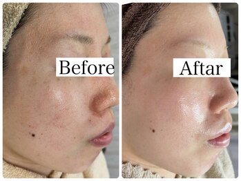 リラビューティー(Lilas Beauty)/肌質改善