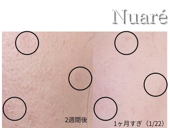 エリア(area.)/14、【韓国発シミケア Nuare】