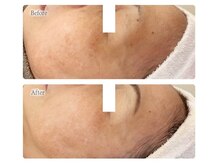 オービーエム 博多阪急店(O.B.M)/【50代シミケア症例】