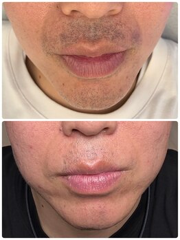 エースマイルイズ(A smile is..)/男性脱毛やってます!