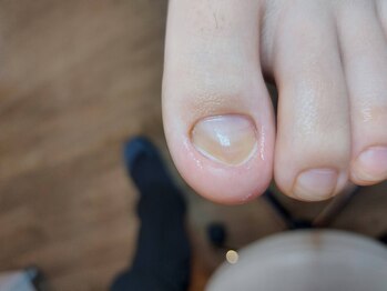 爪切り屋 足楽/肥厚爪はだか育成【after】