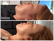 オハナ(OHANA)/フローズンリフトプロ【顔】