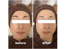 アンド ユウ(& YOU)の雰囲気（ホワイトスノーピーリングフェイスラインスッキリ♪）