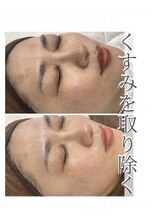 バーグトータルビューティー(bague total beauty)/ニキビや毛穴にハーブピーリング