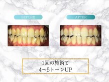 ロイヤル(ROYAL)/【ホワイトニング】before/after