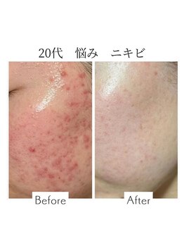 ファニービー 吹田店/20代 ニキビ 10回の施術変化