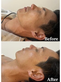 シャイネル(SHYNELL)/エピダーマルスキン2回目