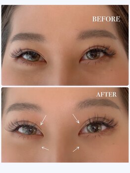 バービーヒルズ/二重、頭痛、クマ、目の開きに