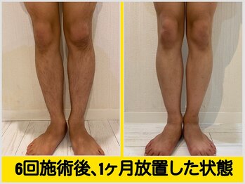 ファシネイト 新宿本店(Fascinate)/脚脱毛！全身脱毛と一緒にも◎