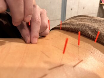 ハリトマト 梅田中崎の写真/【美容鍼50本￥5,500～】美容鍼で肌のターンオーバーを促進し根本改善へ！たるみ/肌質改善/ハリツヤ