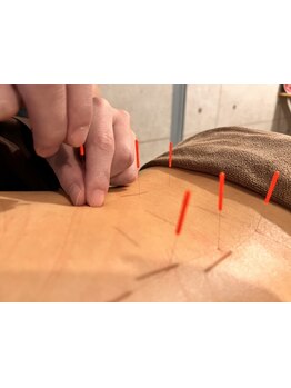 鍼灸施術を受けたい