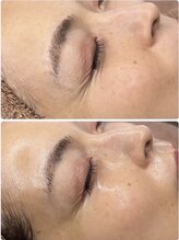 ホワイトアクア 加古川店(WHITE AQUA)/ララピール/兵庫/加古川/毛穴