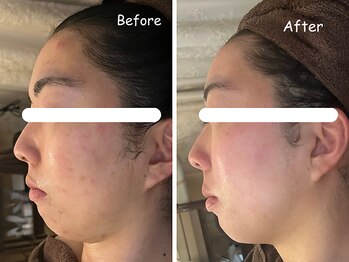 レイ(REI)/◆毛穴開きケア◆