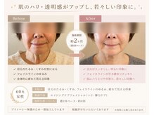 ルル 北仙台の雰囲気(ビフォーアフター、2ヶ月後ハリ、透明感アップ◎)