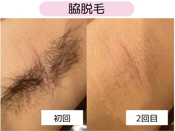 ウルル 四日市駅前店(ULULU)/脇脱毛