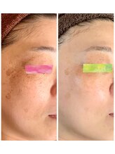 セラ(SERA)/ピンポイントシミケア