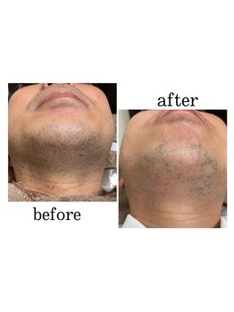 フォルチェ ゆめタウン広島店(Folche)/メンズ顔脱毛