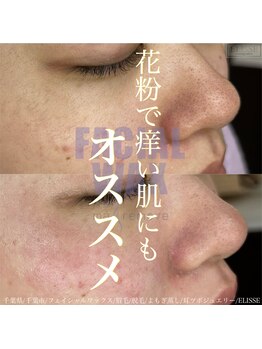 エリス(ELISSE)/花粉で痒い肌にもオススメ！