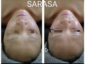 サラサ(SARASA)/更年期世代はターンオーバー重視