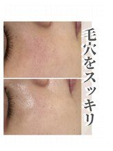 バーグトータルビューティー(bague total beauty)/毛穴はお手入れで変わります！