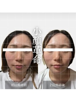 ザ リフト カドモリ 鹿児島 霧島(The Lift KADOMORI)/Before→After